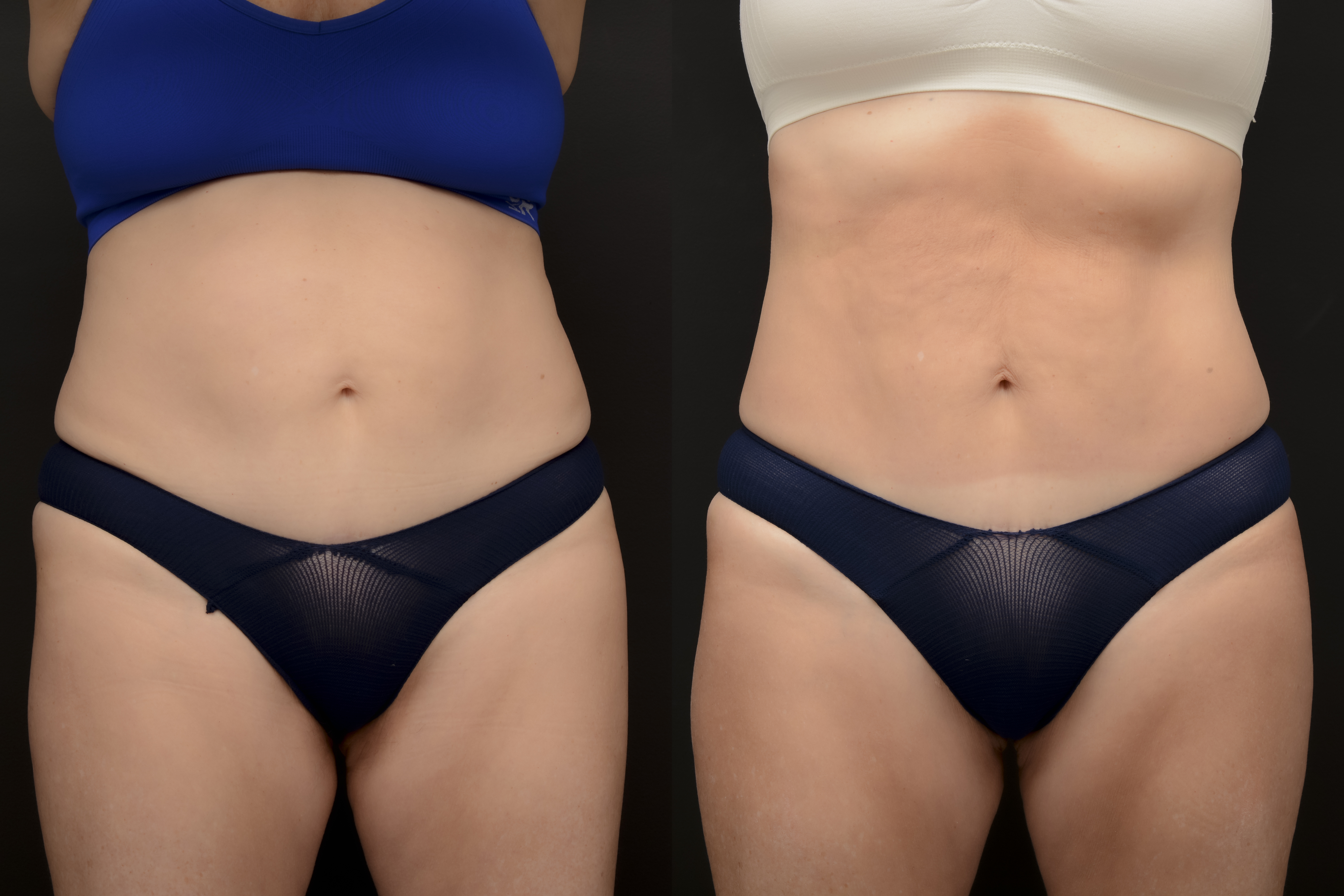 Emsculpt abdomen transformation - before and after